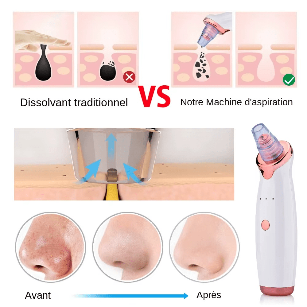 Aspirateur de points noirs happilyskin – Image 9