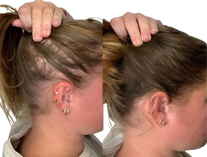 LuxGrow Brosse à cheveux phototherapique repousse des cheveux – Image 4