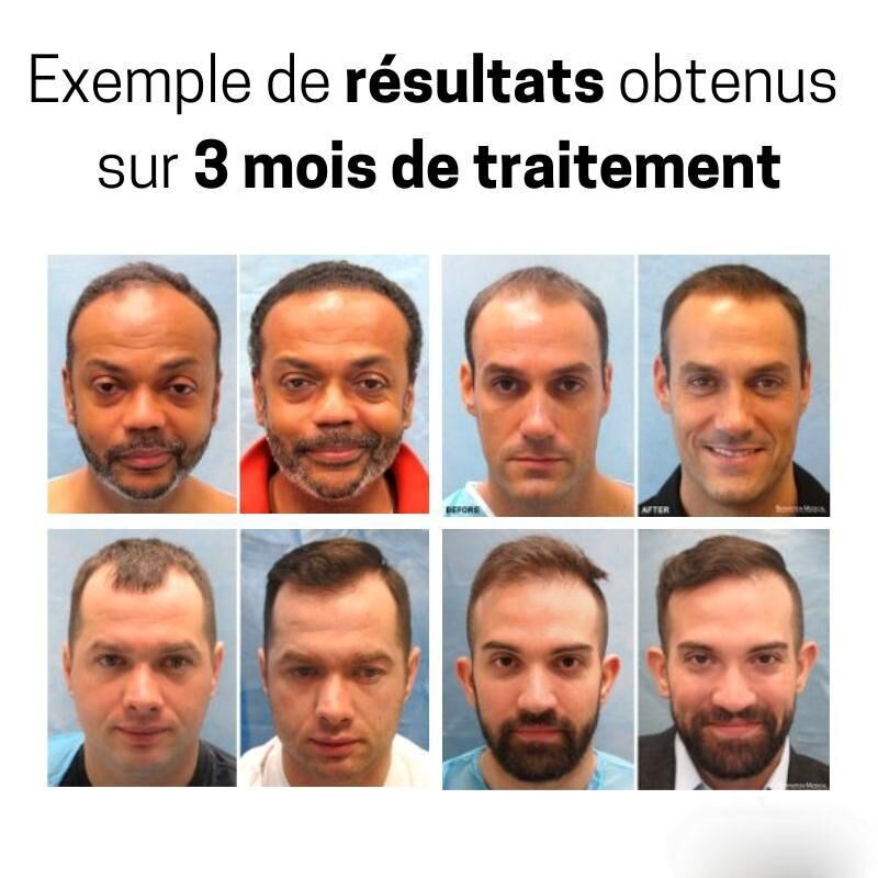 Rouleau repousse cheveux & barbe - instaroller – Image 5