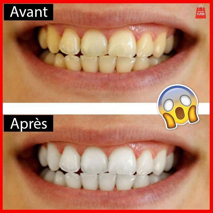 TeethCare Appareil de brossage automatique – Image 4