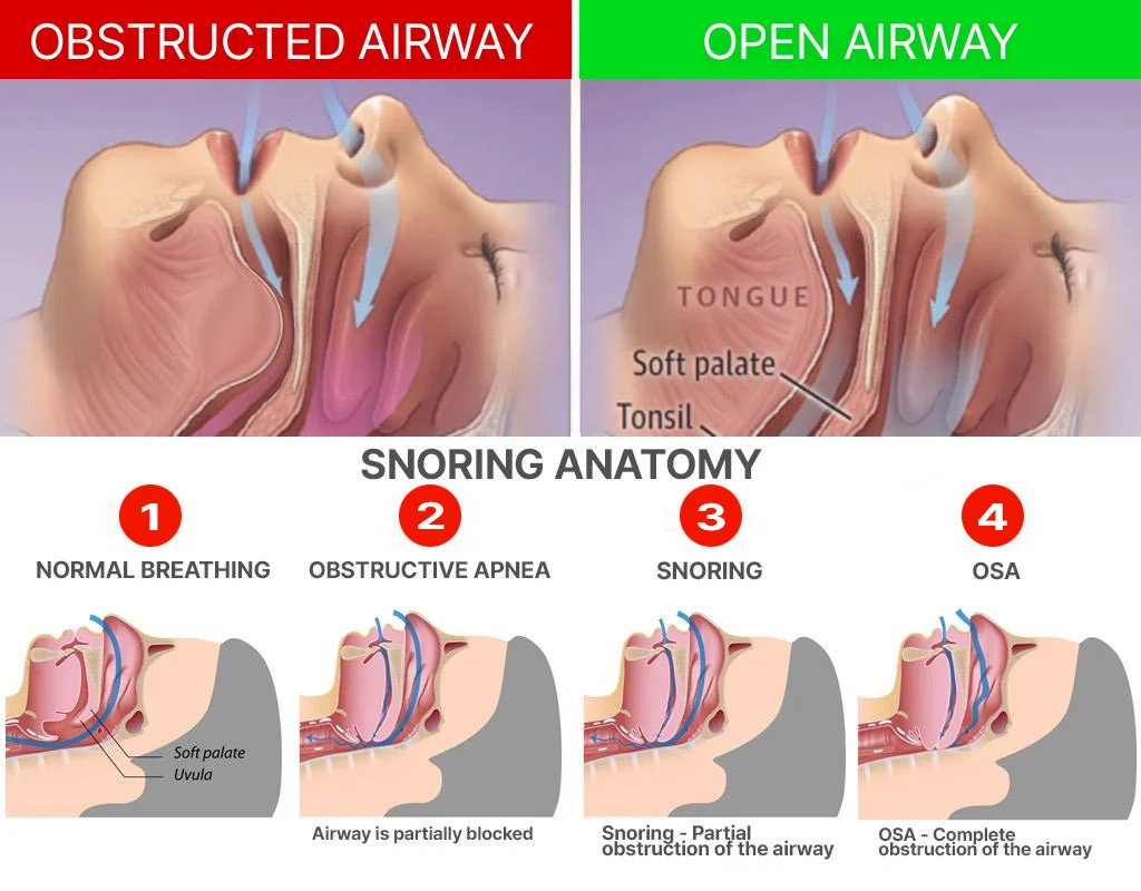 Appareil de protection buccale anti-ronflement PaxySleep