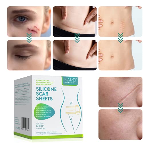 Ruban médical en gel de silicone souple pour l'élimination des cicatrices. – Image 4