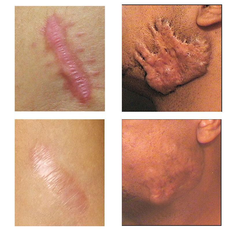 Crème anti-cicatrices jeunesse