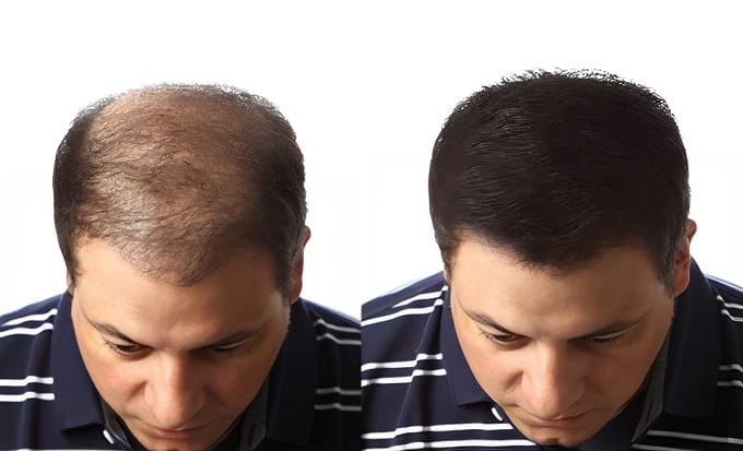 LuxGrow Brosse à cheveux phototherapique repousse des cheveux – Image 9