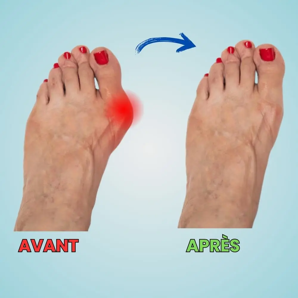 OrthoFlex semelles orthopédiques hallux valgus – Image 6