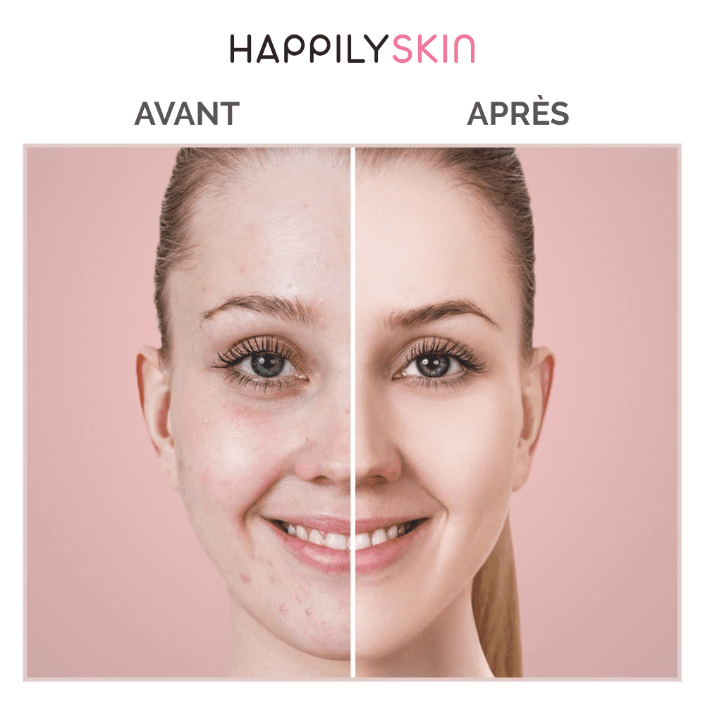 Aspirateur de points noirs happilyskin – Image 3
